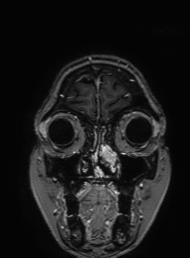 Cavernous hemangioma of the cerebellar falx (Radiopaedia 73025-83724 Coronal T1 C+ 43).jpg