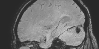 Cavernous hemangioma of the cerebellar falx (Radiopaedia 73025-83724 Sagittal BOLD 59).jpg