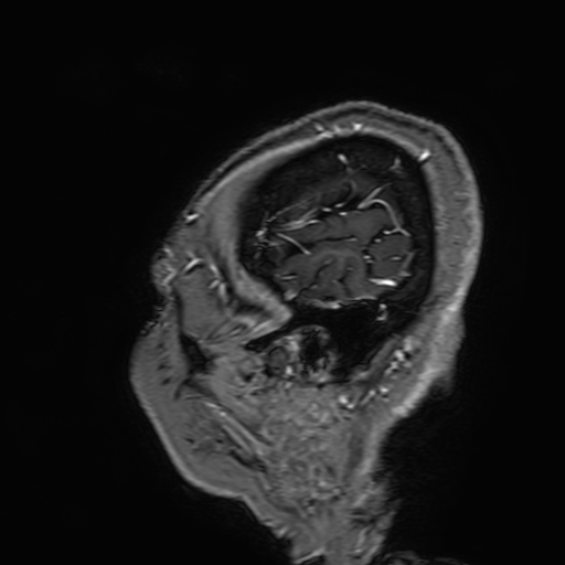 Cavernous hemangioma of the cerebellar falx (Radiopaedia 73025-83724 Sagittal T1 C+ 17).jpg