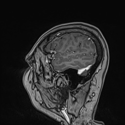 Cavernous sinus meningioma (Radiopaedia 63682-72367 Sagittal T1 C+ 141).jpg