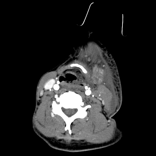 File:Cavernous sinus thrombosis (Radiopaedia 10619-11078 A 21).jpg