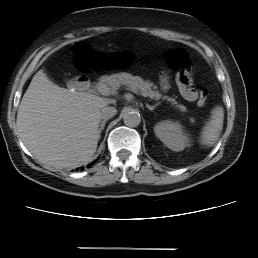 Cavitating pulmonary metastases (Radiopaedia 89545-106544 Axial non-contrast 58).jpg