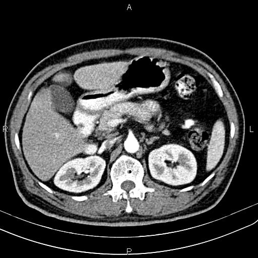 Cecal cancer with appendiceal mucocele (Radiopaedia 91080-108651 A 74).jpg