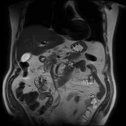 File:Cecal mass causing appendicitis (Radiopaedia 59207-66532 Coronal T2 15).jpg