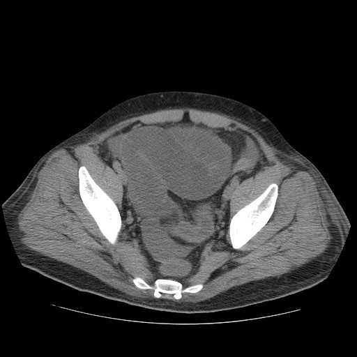 Cecal volvulus (Radiopaedia 28294-28534 Axial non-contrast 78).jpg