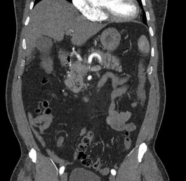 Celiac artery dissection (Radiopaedia 52194-58080 C 28).jpg
