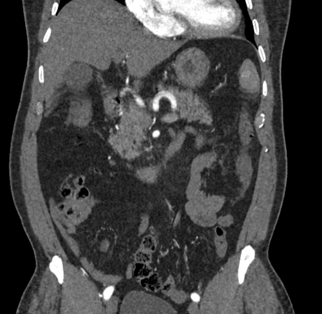 Celiac artery dissection (Radiopaedia 52194-58080 C 31).jpg