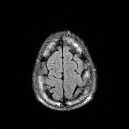 File:Central-variant posterior reversible encephalopathy syndrome (PRES) (Radiopaedia 43880-47358 Axial FLAIR 22).jpg