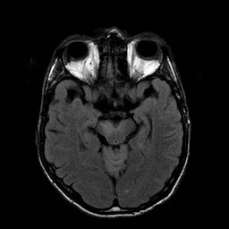 File:Central-variant posterior reversible encephalopathy syndrome (PRES) (Radiopaedia 43880-47358 Axial FLAIR 9).jpg