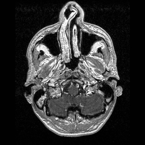 Central-variant posterior reversible encephalopathy syndrome (PRES) (Radiopaedia 43880-47358 Axial T1 C+ 9).jpg
