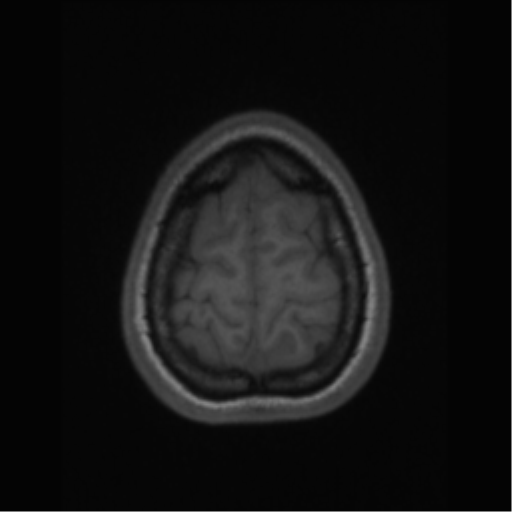 File:Central neurocytoma (Radiopaedia 37664-39557 Axial T1 66).png