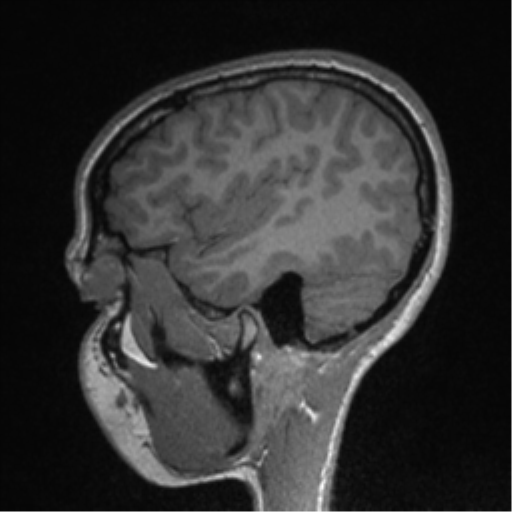 Central neurocytoma (Radiopaedia 37664-39557 Sagittal T1 75).png