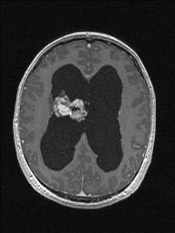 Central neurocytoma (Radiopaedia 56690-63469 Axial T1 C+ 105).jpg