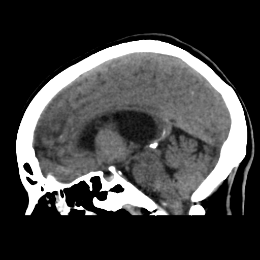 File:Central neurocytoma (Radiopaedia 65317-74346 C 27).png