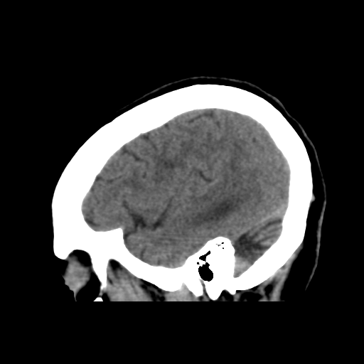 File:Central neurocytoma (Radiopaedia 65317-74346 C 42).png