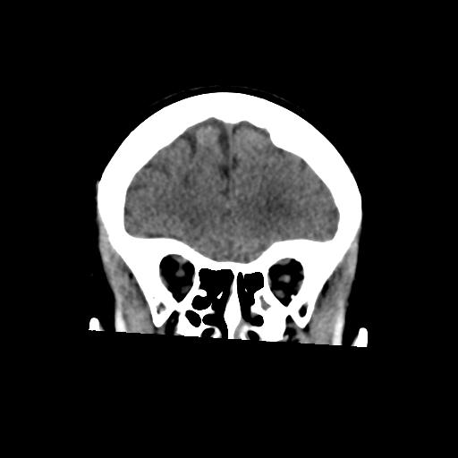 File:Central neurocytoma (Radiopaedia 65317-74346 Coronal non-contrast 16).png