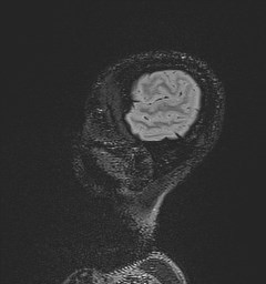 File:Central neurocytoma (Radiopaedia 84497-99872 Sagittal Flair + Gd 23).jpg