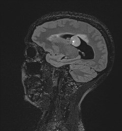 Central neurocytoma (Radiopaedia 84497-99872 Sagittal Flair + Gd 54).jpg