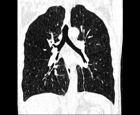 Centrilobular pulmonary emphysema (Radiopaedia 62468-70718 Coronal lung window 41).jpg