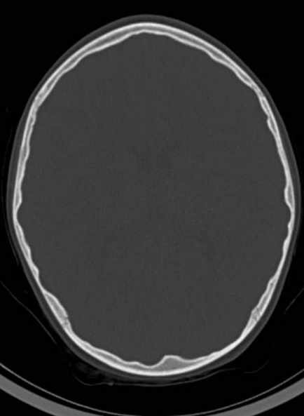Cerebellar abscess (Radiopaedia 73727-84527 Axial bone window 41).jpg