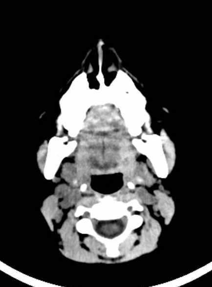 File:Cerebellar abscess (Radiopaedia 73727-84527 Axial non-contrast 8).jpg