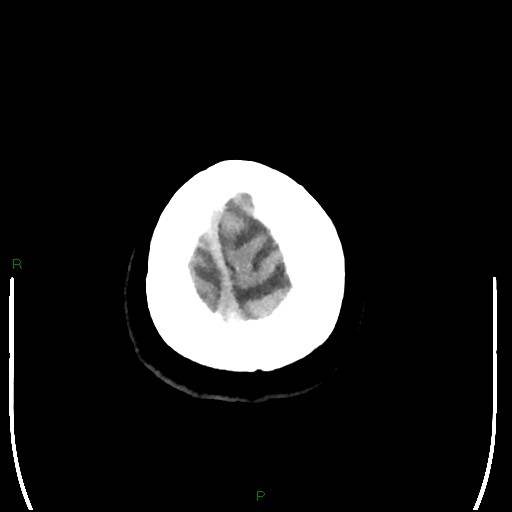 File:Cerebellar abscess (Radiopaedia 78135-90671 Axial non-contrast 107).jpg