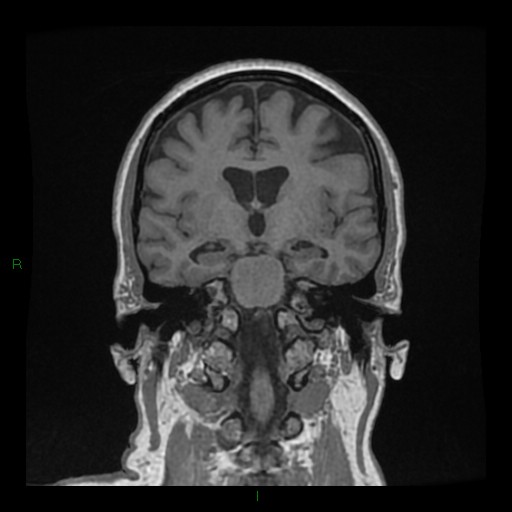 File:Cerebellar abscess (Radiopaedia 78135-90678 Coronal T1 C+ 82).jpg