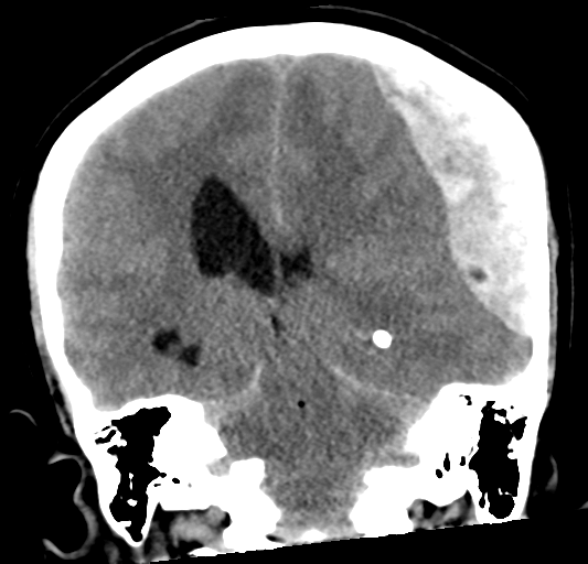 File:Cerebellar ependymoma complicated by post-operative subdural hematoma (Radiopaedia 83322-97737 Coronal non-contrast 23).png