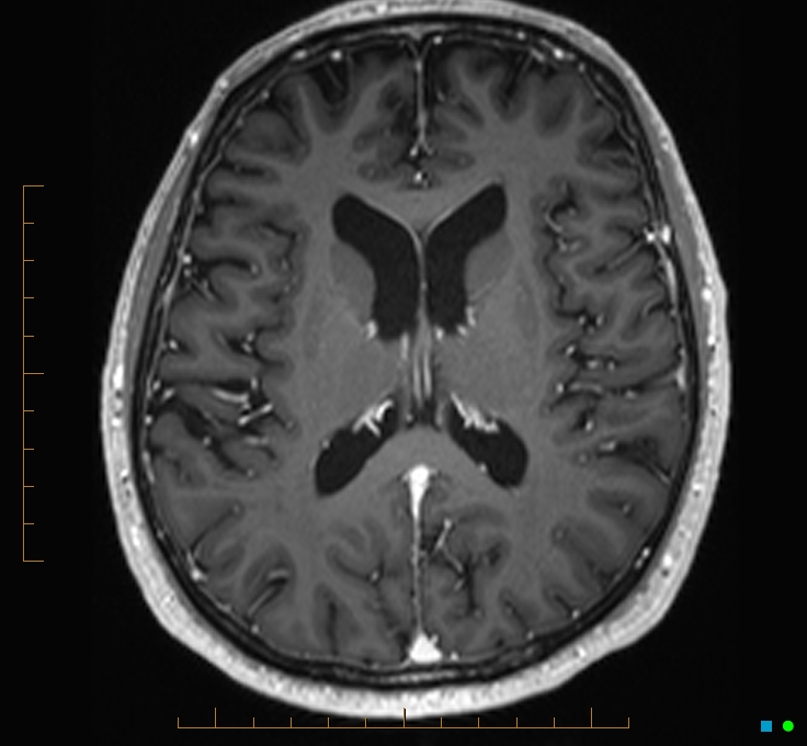 Cerebellar gangliocytoma (Radiopaedia 65377-74422 Axial T1 C+ 76).jpg