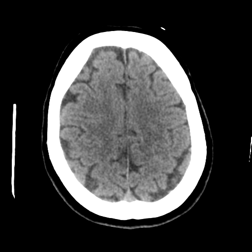 Cerebellar metastasis (cystic appearance) (Radiopaedia 41395-44258 Axial non-contrast 41).png