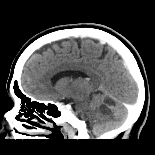 Cerebellar metastasis (cystic appearance) (Radiopaedia 41395-44258 F 30).png