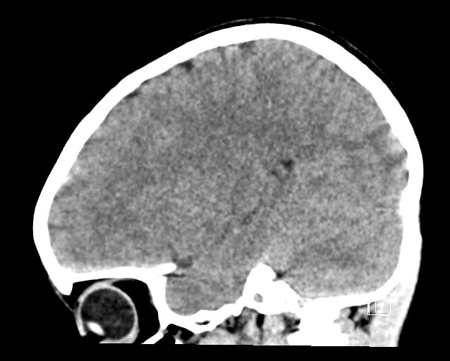 File:Cerebellar stroke (Radiopaedia 32202-33149 B 22).png