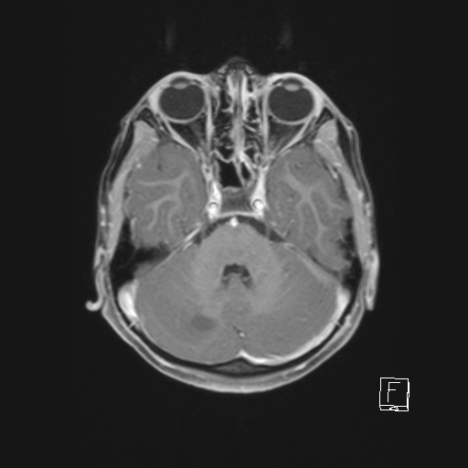 Cerebellar stroke (Radiopaedia 32202-33150 Axial T1 C+ 27).png
