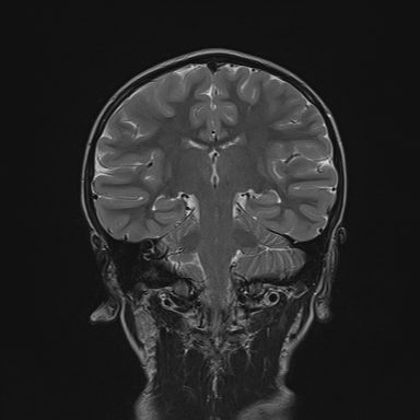 File:Cerebellar stroke (Radiopaedia 32202-33150 Coronal T2 18).png