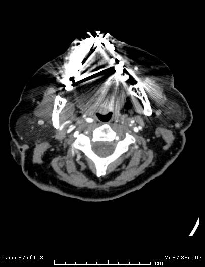 File:Cerebellar strokes due to intracranial giant cell arteritis (Radiopaedia 68799-78510 CT angiogram 87).jpg