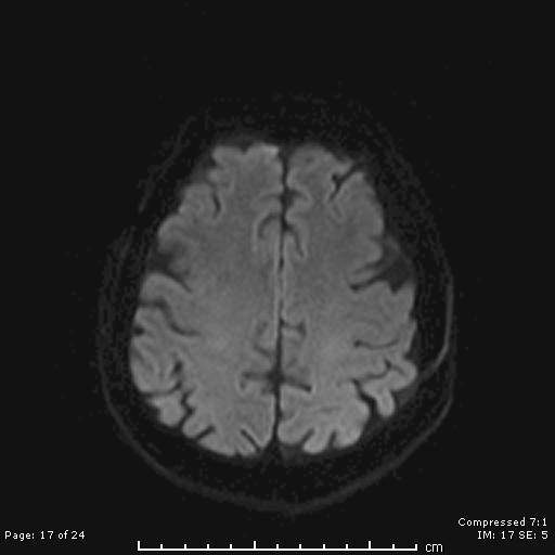 File:Cerebellar strokes due to intracranial giant cell arteritis (Radiopaedia 68799-81713 Axial DWI 17).jpg
