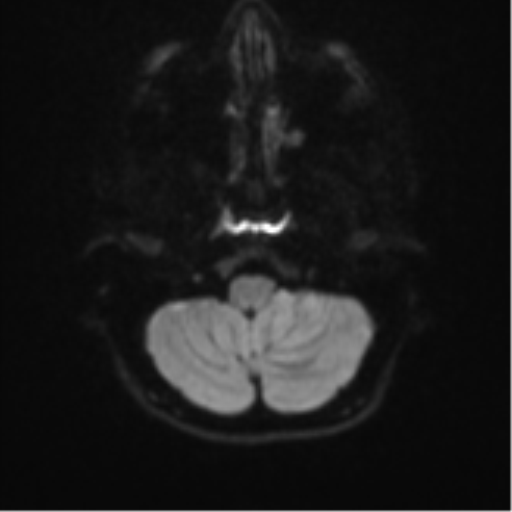 Cerebellar tuberculomas (Radiopaedia 46939-51472 Axial DWI 33).png