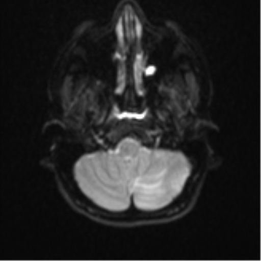 Cerebellar tuberculomas (Radiopaedia 46939-51472 Axial DWI 5).png