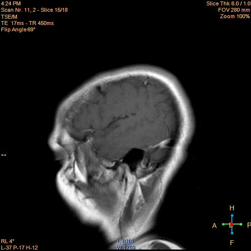 File:Cerebellopontine angle meningioma (Radiopaedia 22488-22525 Sagittal T1 C+ 15).jpg