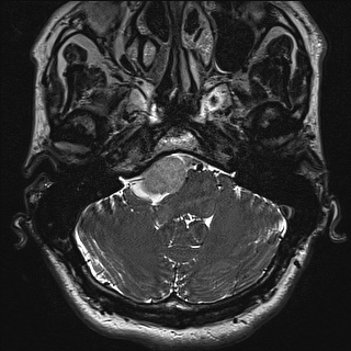 Cerebellopontine angle meningioma (Radiopaedia 72983-83680 Axial FIESTA 14).jpg