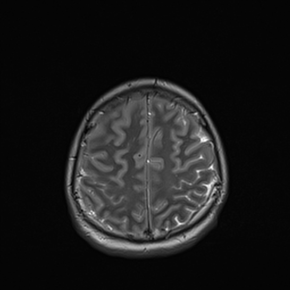 Cerebral abscess (Radiopaedia 24212-24478 Axial T2 48).jpg