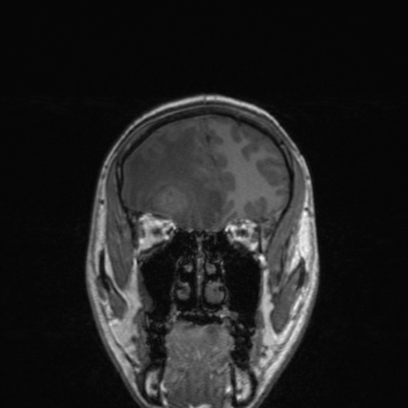 File:Cerebral abscess (Radiopaedia 24212-24478 Coronal T1 61).jpg