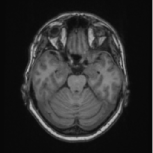 Cerebral abscess from pulmonary arteriovenous malformation (Radiopaedia 86275-102291 Axial T1 28).png