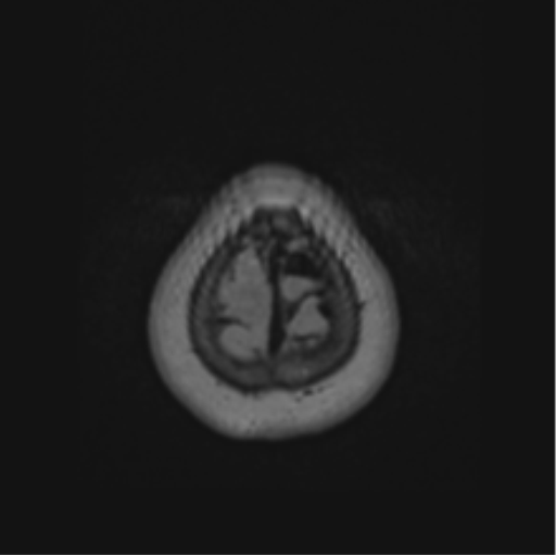 Cerebral abscess from pulmonary arteriovenous malformation (Radiopaedia 86275-102291 J 71).png
