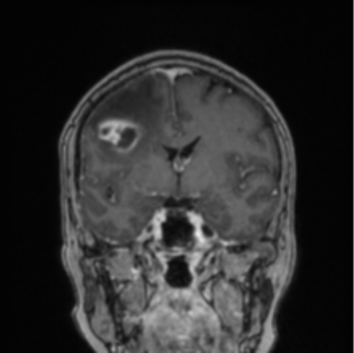 Cerebral abscess from pulmonary arteriovenous malformation (Radiopaedia 86275-102291 L 52).png
