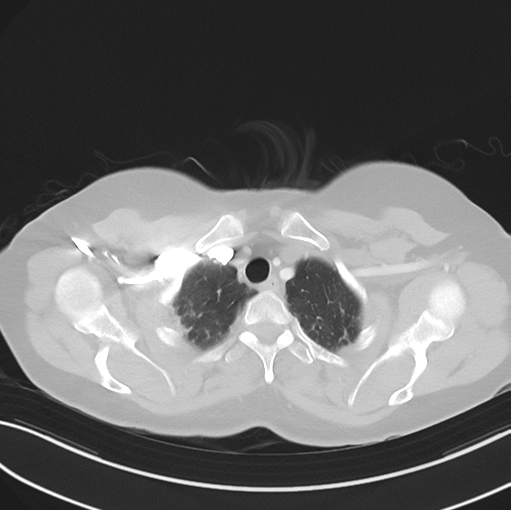 Cerebral abscess from pulmonary arteriovenous malformation (Radiopaedia 86275-102292 Axial lung window 11).png