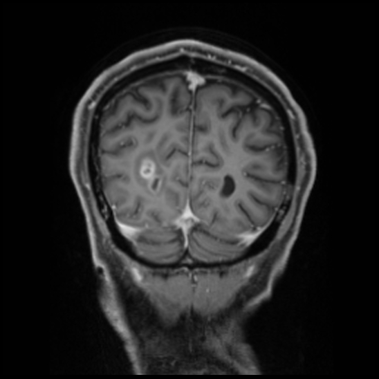 Cerebral abscess with ventriculitis (Radiopaedia 78965-91878 Coronal T1 C+ 53).jpg