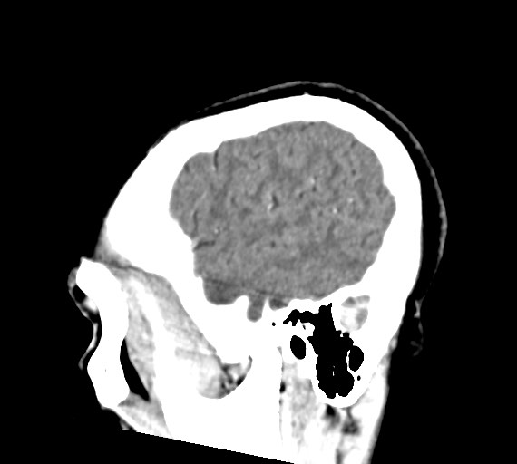 Cerebral abscesses (Radiopaedia 70458-80568 Sagittal Contrast 46).jpg