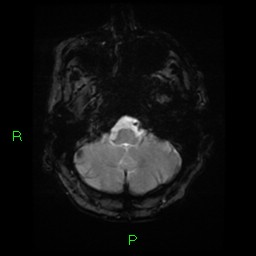 File:Cerebral amyloid angiopathy-associated lobar intracerebral hemorrhage (Radiopaedia 58376-65512 Axial Gradient Echo 22).jpg