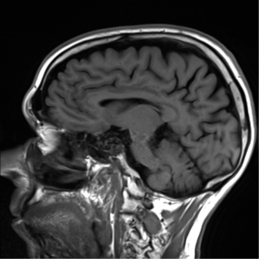 File:Cerebral amyloid angiopathy (Radiopaedia 46082-50433 Sagittal T1 12).png